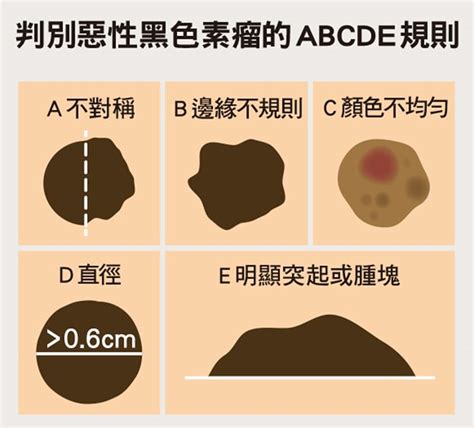 好痣顏色|這是痣，還是黑色素癌？